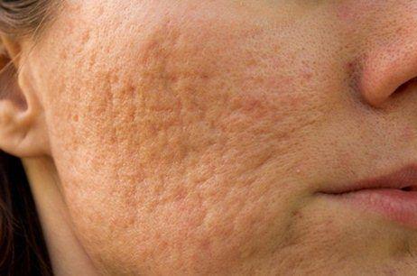 Collection Of Best Acne Scars Home Remedy And Natural Cures