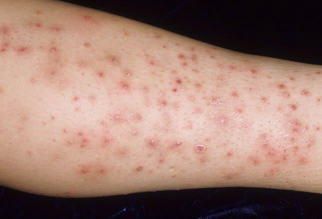 Skin Infection Home Remedy And Other Selective Natural Cures