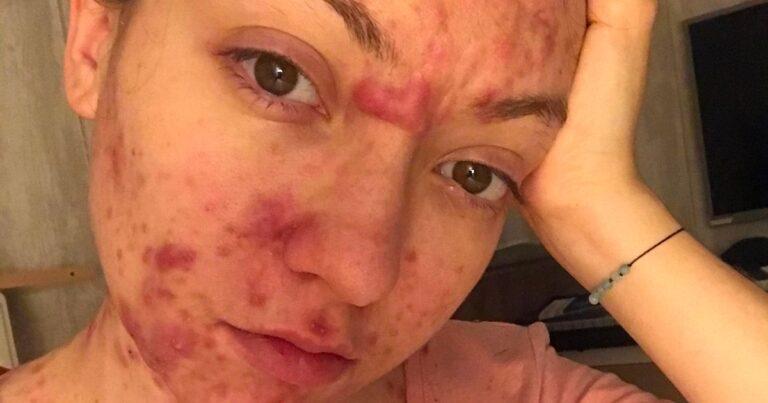 'My acne was so bad, I stopped having sex - but now I've found a natural cure' - Mirror Online