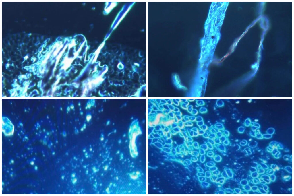 Italy: Peer-Reviewed Study Finds 'Metal-Like Objects' in 94% of Individuals With Reported mRNA Vaccine Side Effects