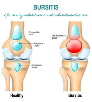 10 Natural Remedies for Bursitis That Work Like a Charm!