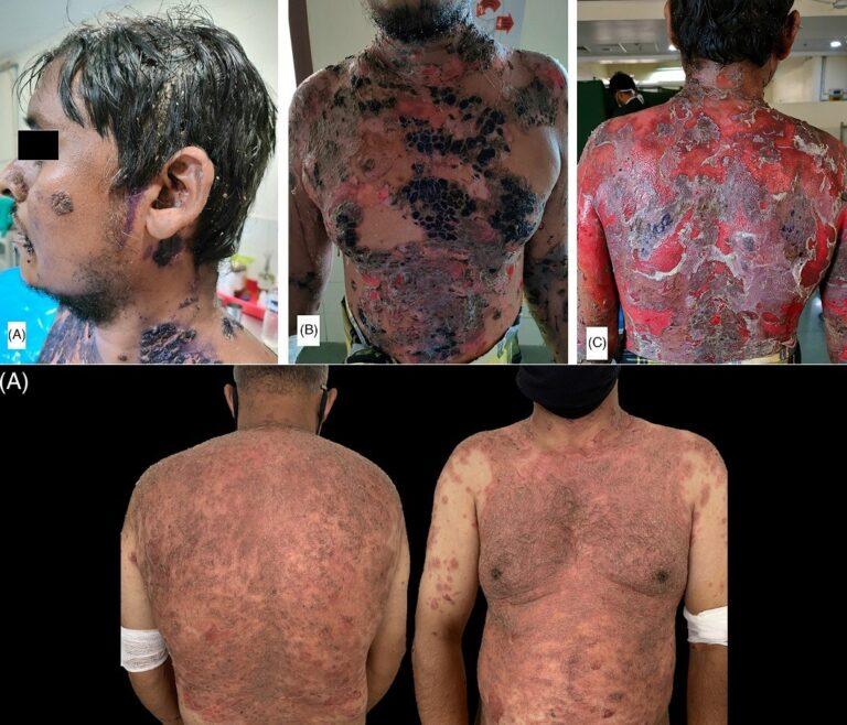Worse than Monkeypox? Multiple Cases of Skin Diseases Following COVID-19 Vaccination Start Appearing in the Medical Journals