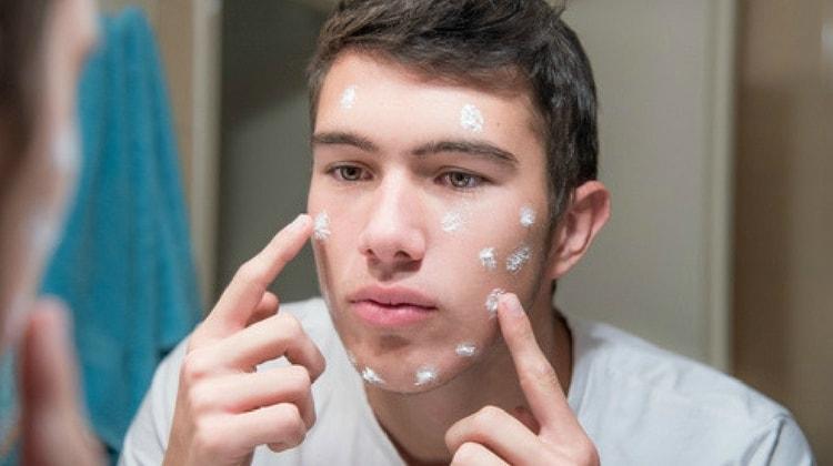Natural Remedies For Moderate To Severe Acne