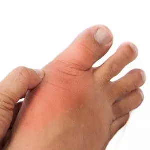 What Are the Natural Remedies for Gout? | The People's Pharmacy