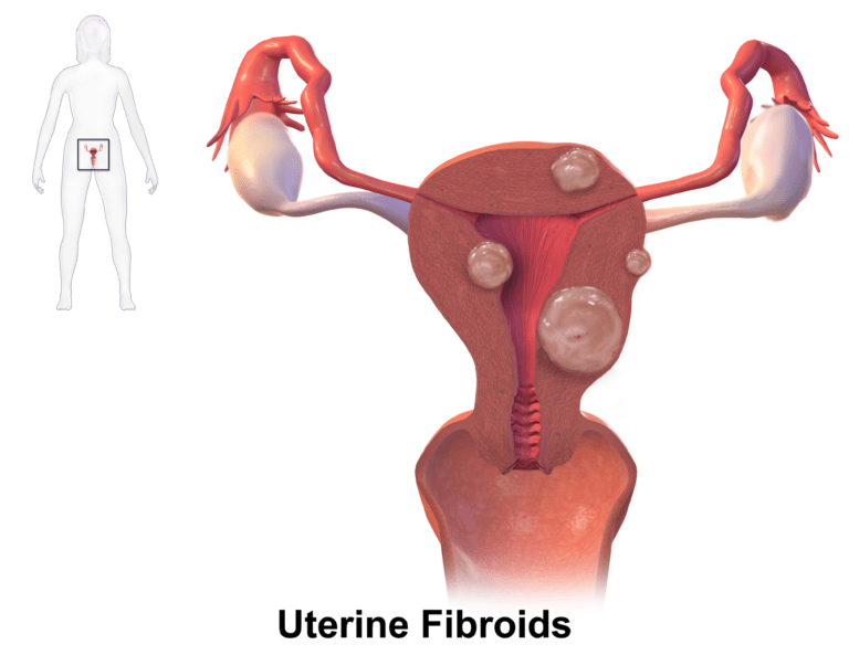 Can you get rid of uterine fibroids without surgery?  Natural Cures for Asherman’s Syndrome and Uterine Fibroids | Alive-N-Healthy