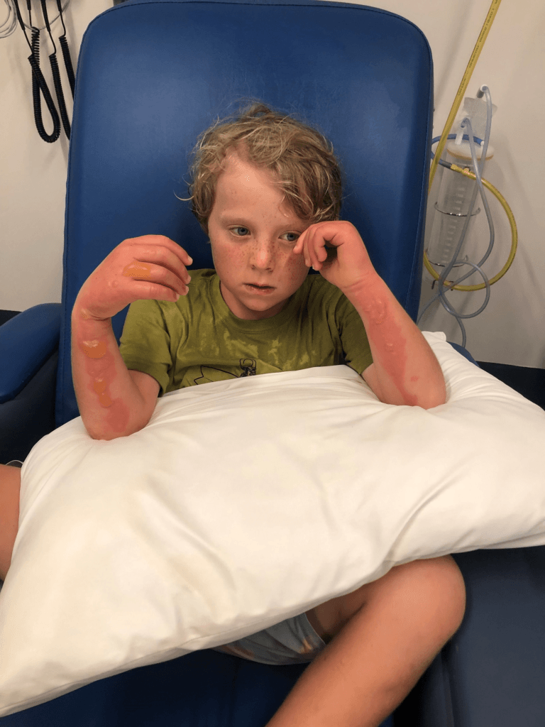 Byron Shire boy hospitalised with 'margarita burns' after juicing limes and going in the sun - ABC News