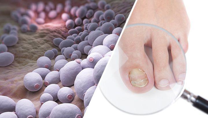 32 Signs Fungus Might Be Taking Over Your Body