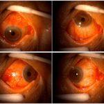 20,000% Increase in Retinal Eye Damage Following COVID-19 Vaccination