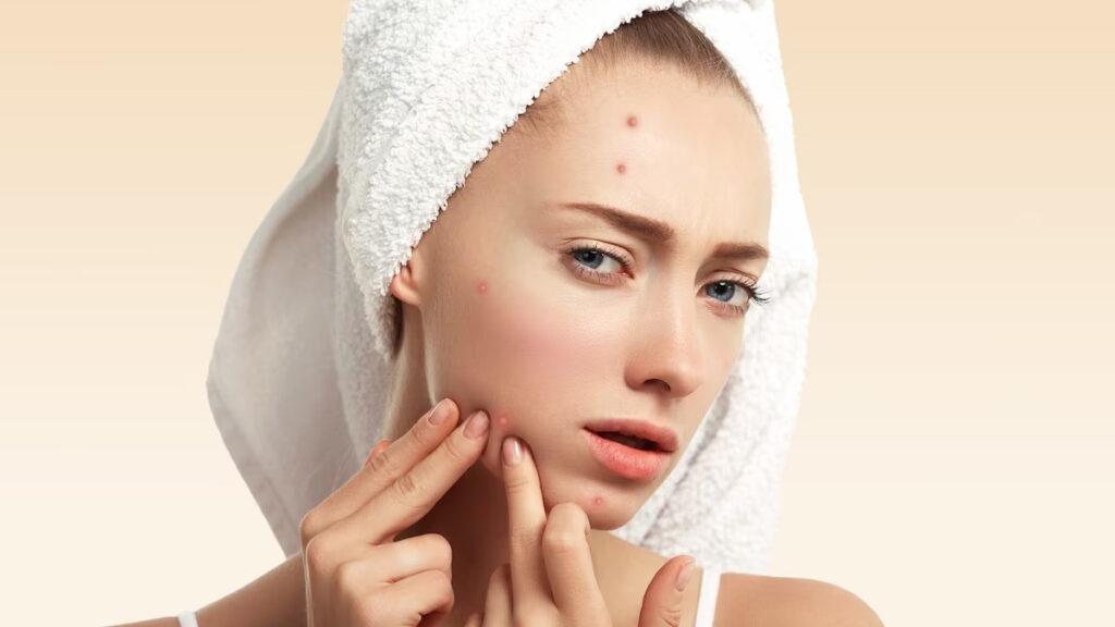 Natural Remedies To Get Over Stress Pimples
