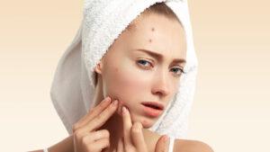 Natural Remedies To Get Over Stress Pimples