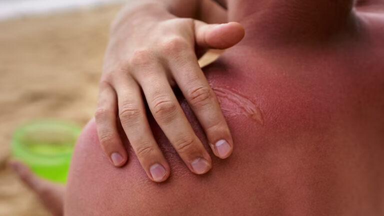 Natural Remedies To Treat Heat Rashes