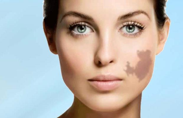 Birthmark Removal Natural Remedies to try at home