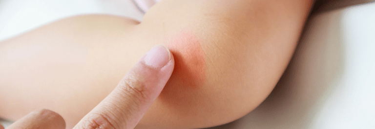 How to Soothe a Rash on Knees with Natural Remedies