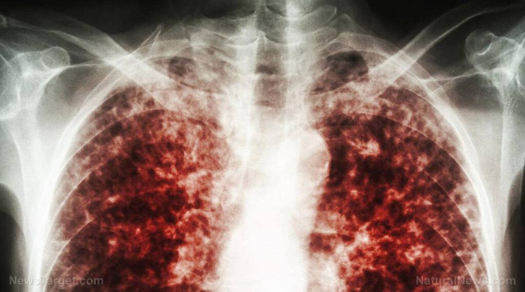 Cover-up of tuberculosis outbreak at Cape Cod migrant encampment EXPOSED by local media – NaturalNews.com