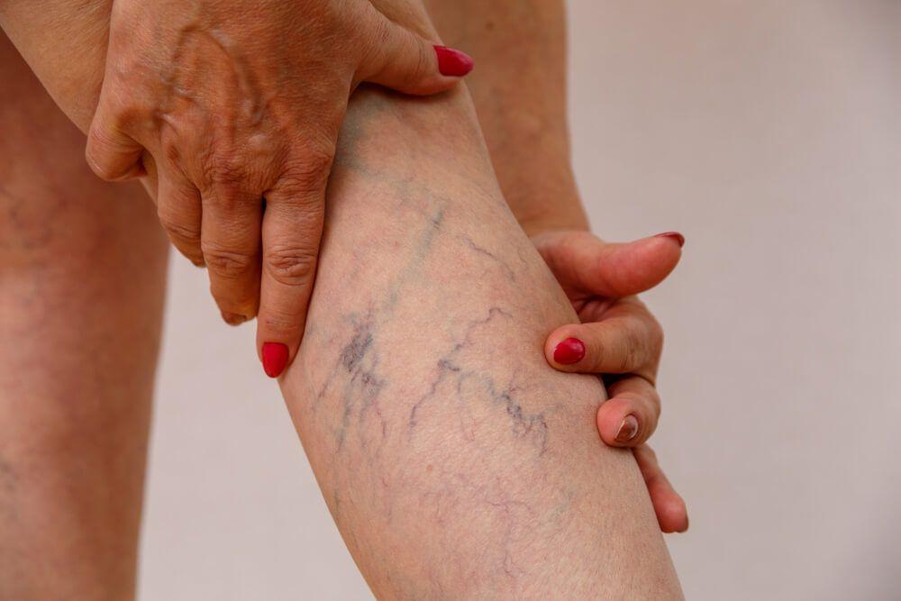 Natural Remedies for Spider Veins