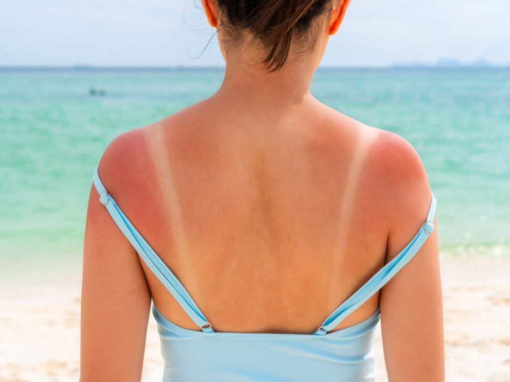 Tame sunburn pain with these 3 natural remedies