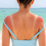 Tame sunburn pain with these 3 natural remedies
