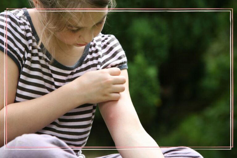 10 natural remedies for insect bites: Expert-approved tips to soothe itching and reduce swelling | GoodTo