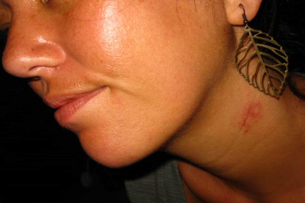 Top Natural Remedies On How To Get Rid Of Hickeys