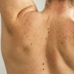 Best Chest Acne Treatment (5 Natural Remedies You Can Do at Home)