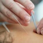 Fine acupuncture needles inserted into the skin during a treatment for chronic pain