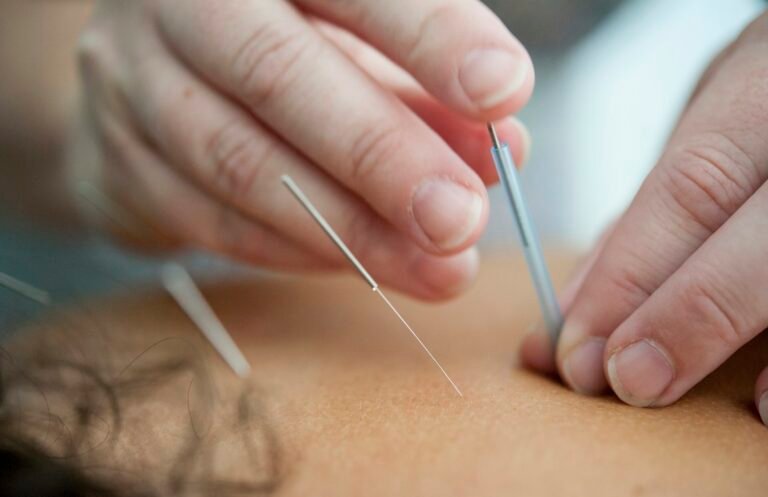 Fine acupuncture needles inserted into the skin during a treatment for chronic pain